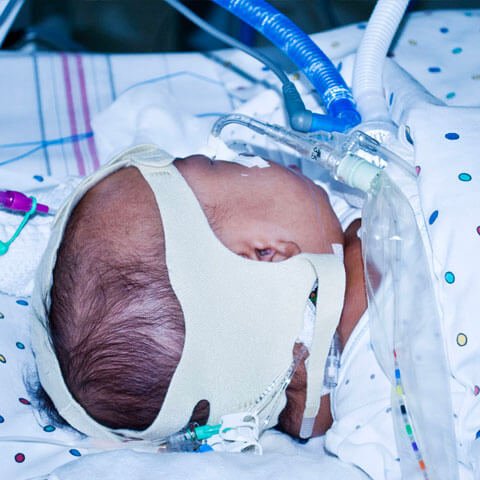 Baby in hospital bed with oxygen tubes